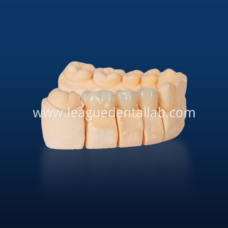Full Zirconia crown,Full contour zirconia,Solid Zirconia,Zirconia,Monolithic Zirconia